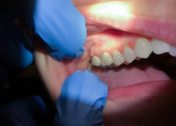 Best Knocked-Out Tooth (Avulsed Tooth) Treatment in Valdese, NC